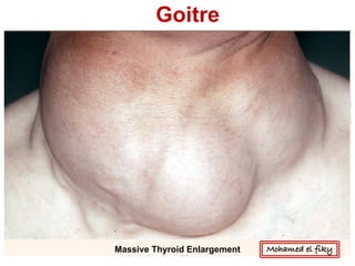 Massive Thyroid Enlargement
Goitre
Mohamed el fiky
 
