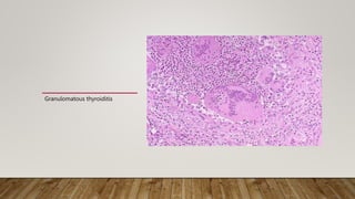 Granulomatous thyroiditis
 