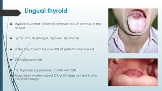 Lingual thyroid
🠶 Thyroid tissue that persists in foramen cecum at base of the
tongue
🠶 Symptoms: dysphagia, dyspnea, dysphonia
🠶 Is the only thyroid tissue in 70% of patients who have it
🠶 2% malignancy risk
🠶 Tx: thyroxine suppression; abolish with 131I
🠶 Resection if worried about CA or if it does not shrink after
medical therapy
 
