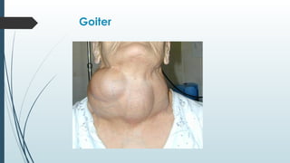 Goiter
 