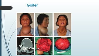 Goiter
 