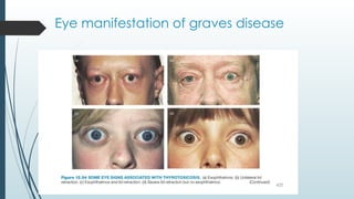 Eye manifestation of graves disease
 