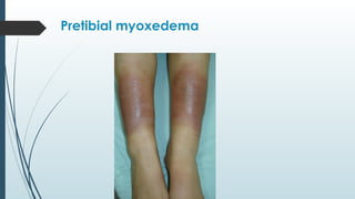 Pretibial myoxedema
 