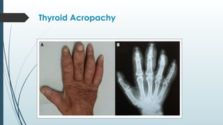 Thyroid Acropachy
 