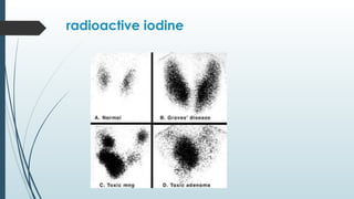 radioactive iodine
 