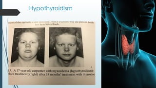 Hypothyroidism
 