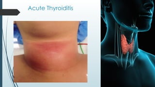 Acute Thyroiditis
 