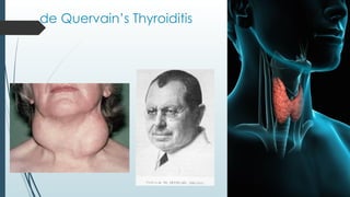 de Quervain’s Thyroiditis
 