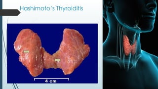 Hashimoto’s Thyroiditis
 