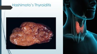 Hashimoto’s Thyroiditis
 