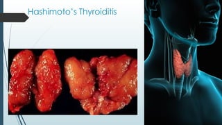 Hashimoto’s Thyroiditis
 