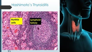 Hashimoto’s Thyroiditis
 