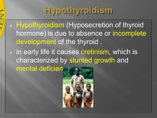 HypothyroidismHypothyroidism (Hyposecretion of thyroid hormone) is due to absence or incompletedevelopment of the thyroid .