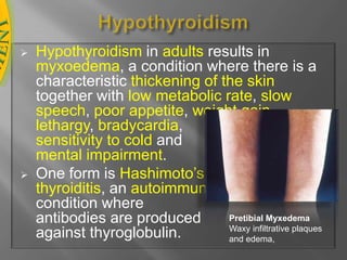 in early life it causes cretinism, which is characterized by stuntedgrowth and mentaldeficiency.HypothyroidismHypothyroidism in adults results in myxoedema, a condition where there is a characteristic thickening of the skin together with low metabolic rate, slow speech, poor appetite, weight gain,                                   lethargy, bradycardia,                                sensitivity to cold and                                            mental impairment. 