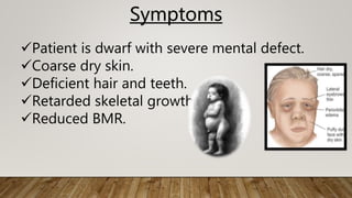 Symptoms
Patient is dwarf with severe mental defect.
Coarse dry skin.
Deficient hair and teeth.
Retarded skeletal growth.
Reduced BMR.
 