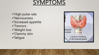 High pulse rate
Nervousness
Increased appetite
Tremors
Weight loss
Clammy skin
fatigue
SYMPTOMS
 
