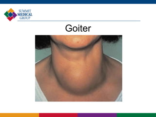 Goiter
 