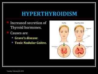HYPERTHYROIDISM
 Increased secretion of
Thyroid hormones.
 Causes are
 Grave’s disease
 Toxic Nodular Goitre.
Tuesday, February 20, 2018
 