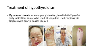 Treatment of hypothyroidism
• Myxedema coma is an emergency situation, in which liothyronine
(only indication) can also be used (It should be used cautiously in
patients with heart diseases like AF).
 