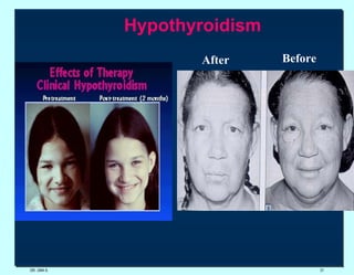 DR. UMA K. Hypothyroidism After  Before  