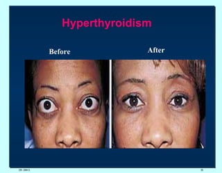 DR. UMA K. Hyperthyroidism  Before  After  