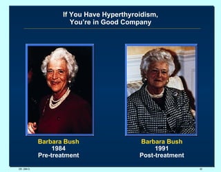 If You Have Hyperthyroidism, You’re in Good Company DR. UMA K. Barbara Bush 1984 Pre-treatment Barbara Bush 1991 Post-treatment 