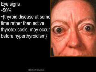 Eye signs
•50%
•{thyroid disease at some
time rather than active
thyrotoxicosis, may occur
before hyperthyroidism}
ABOUBAKRELNASHAR
 