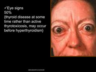Eye signs
50%
{thyroid disease at some
time rather than active
thyrotoxicosis, may occur
before hyperthyroidism}
ABOUBAKR ELNASHAR
 