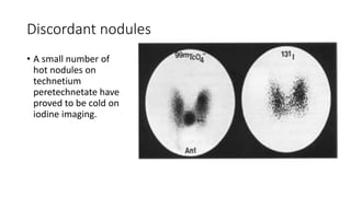 Discordant nodules
• A small number of
hot nodules on
technetium
peretechnetate have
proved to be cold on
iodine imaging.
 