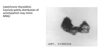 Late(chronic thyroiditis)-
Coarsely patchy distribution of
activity(which may mimic
MNG)
 