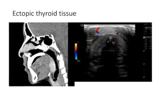 Ectopic thyroid tissue
 