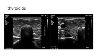 thyroiditis
 