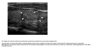 US image of a thyroid nodule (arrowheads) containing multiple fine punctuate echogenicity's
(arrow) with no comet-tail artifact, indicating high suspicion for malignancy. FNA and surgery confirmed PTC. (Reproduced from Frates MC.
Management of thyroid nodules detected at US: Society of Radiologists in Ultrasound consensus conference statement. Radiology2005;237:794–800;
with permission.)
 