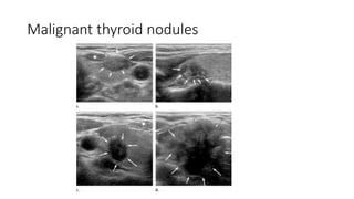 Malignant thyroid nodules
 