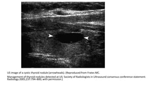 US image of a cystic thyroid nodule (arrowheads). (Reproduced from Frates MC.
Management of thyroid nodules detected at US: Society of Radiologists in Ultrasound consensus conference statement.
Radiology 2005;237:794–800; with permission.)
 