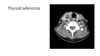 Thyroid adenoma
 