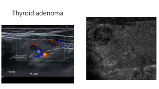 Thyroid adenoma
 