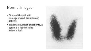 Normal images
• Bi-lobed thyroid with
homogenous distribution of
activity.
• In a small number of patients, a
pyramidal lobe may be
indemnified.
 