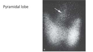 Pyramidal lobe
 