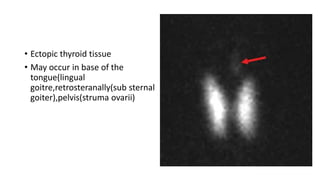 • Ectopic thyroid tissue
• May occur in base of the
tongue(lingual
goitre,retrosteranally(sub sternal
goiter),pelvis(struma ovarii)
 