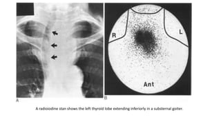 A radioiodine stan shows the left thyroid lobe extending inferiorly in a substernal goiter.
 