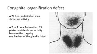 Congenital organification defect
• A 24 hour radioiodine scan
shows no activity.
• A 2 to 4 hour Technetium 99
pertechnetate shows activity
because the trapping
mechanism of the gland is intact
 