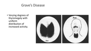 Grave’s Disease
• Varying degrees of
thyromegaly with
uniform
distribution of
increased activity.
 