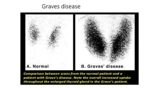 Graves disease
 
