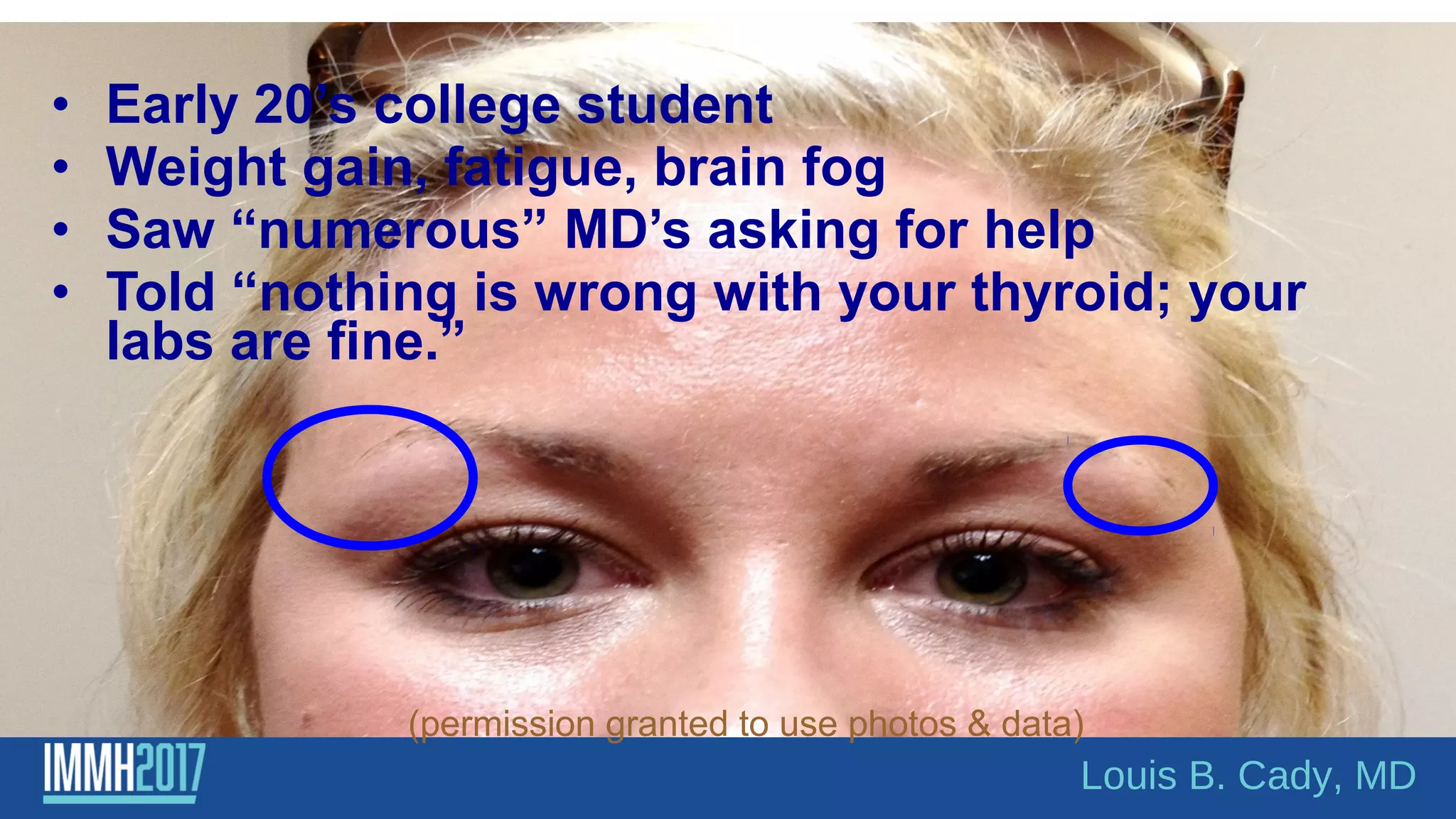 • Early 20’s college student
• Weight gain, fatigue, brain fog
• Saw “numerous” MD’s asking for help
• Told “nothing is wrong with your thyroid; your
labs are fine.”
(permission granted to use photos & data)
Louis B. Cady, MD
 