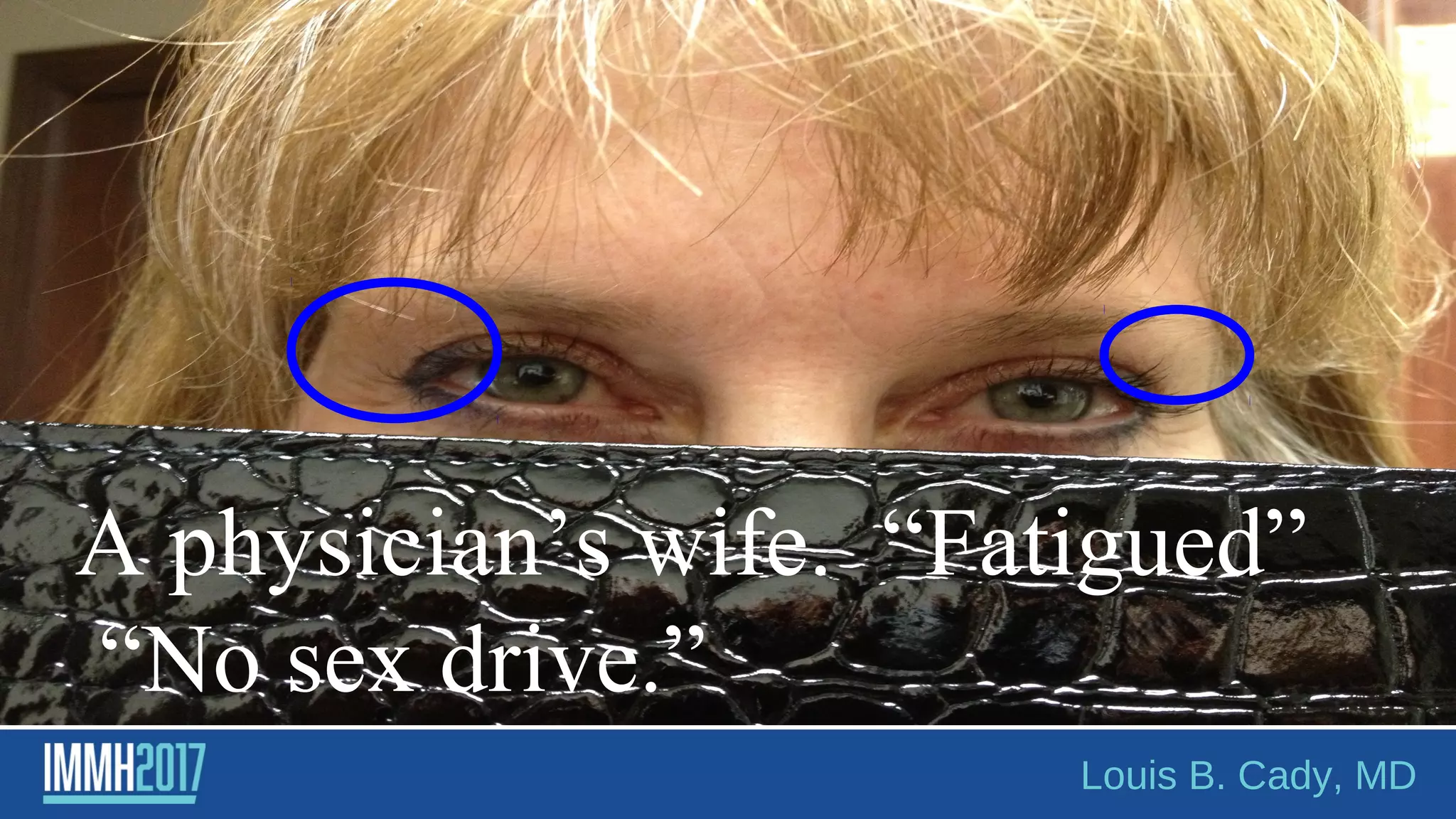 A physician’s wife. “Fatigued”
“No sex drive.”
Louis B. Cady, MD
 