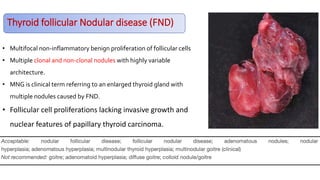 Thyroid follicular Nodular disease (FND)
• Multifocal non-inflammatory benign proliferation of follicular cells
• Multiple clonal and non-clonal nodules with highly variable
architecture.
• MNG is clinical term referring to an enlarged thyroid gland with
multiple nodules caused by FND.
• Follicular cell proliferations lacking invasive growth and
nuclear features of papillary thyroid carcinoma.
 