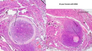 35 year Female with MNG
S-21612/2022
 