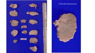 27/M
, 27/M with thyrotoxicosis
 