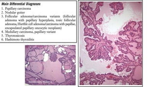 Papillary lesions: D/D
Sandersons Polsters
 
